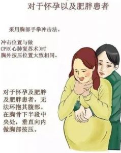 海姆立克法