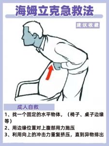 海姆立克法