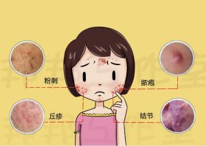 諷刺痤瘡